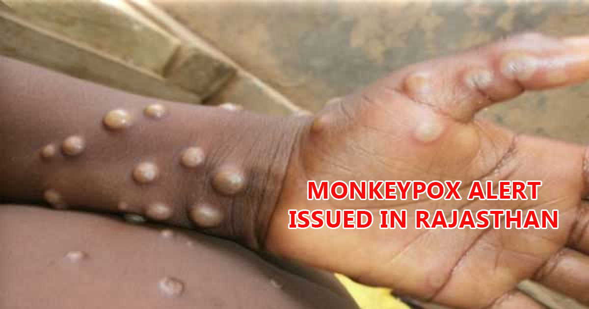 Monkeypox alert issued in Rajasthan